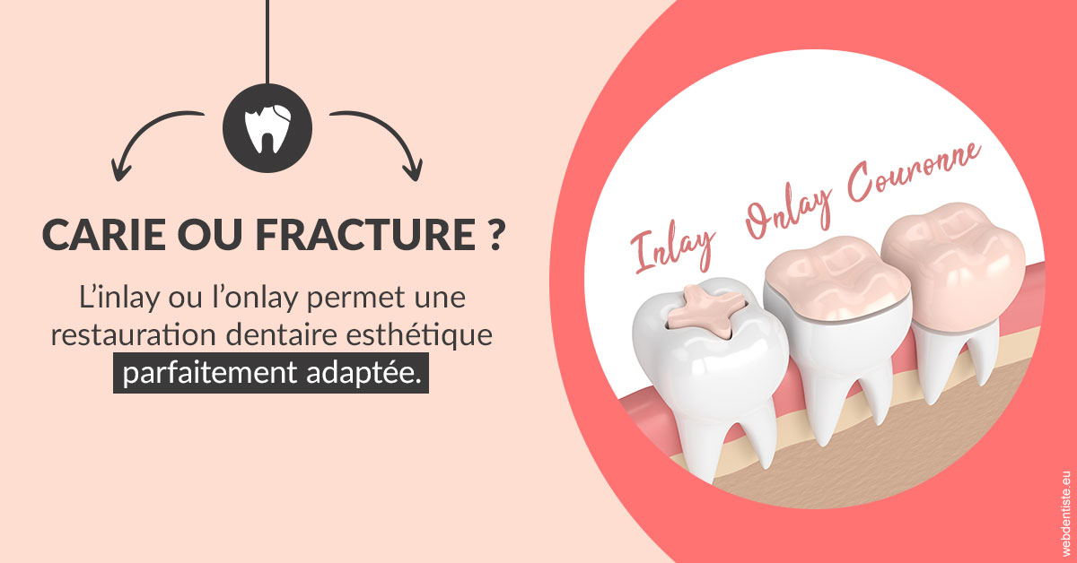https://dr-vincent-maire.chirurgiens-dentistes.fr/T2 2023 - Carie ou fracture 2
