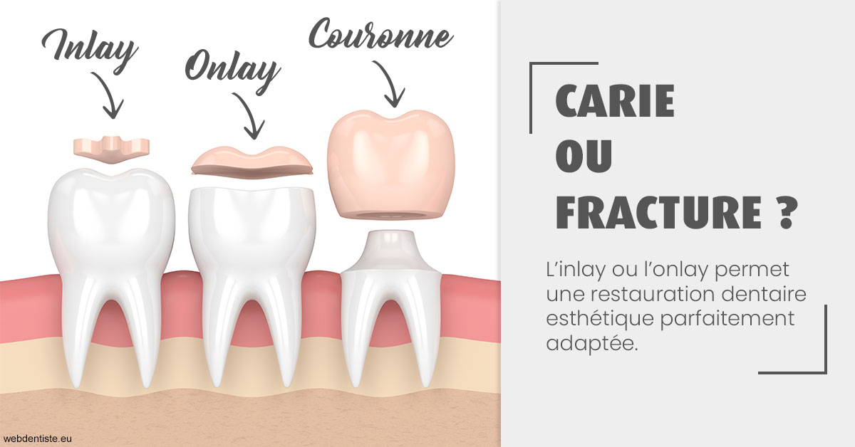 https://dr-vincent-maire.chirurgiens-dentistes.fr/T2 2023 - Carie ou fracture 1