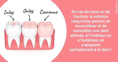 https://dr-vincent-maire.chirurgiens-dentistes.fr/L'INLAY ou l'ONLAY 2